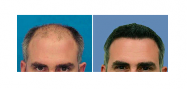 Пересадка волос DHI до и после. Сапфир для пересадки волос. Как происходит пересадка волос. Пересадка волос сапфире. Пересадка волос красноярск